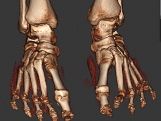 Hammertoe 3D