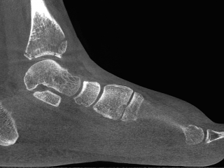 Tibia Fractures Sagittal