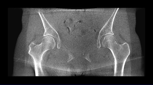 Female Hip