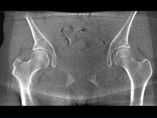 Female Hip