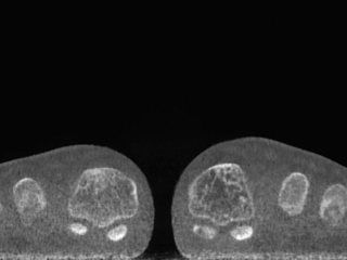 Pediatric Coronal