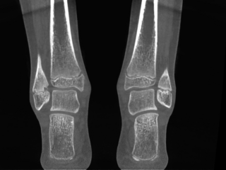 Pediatric Coronal