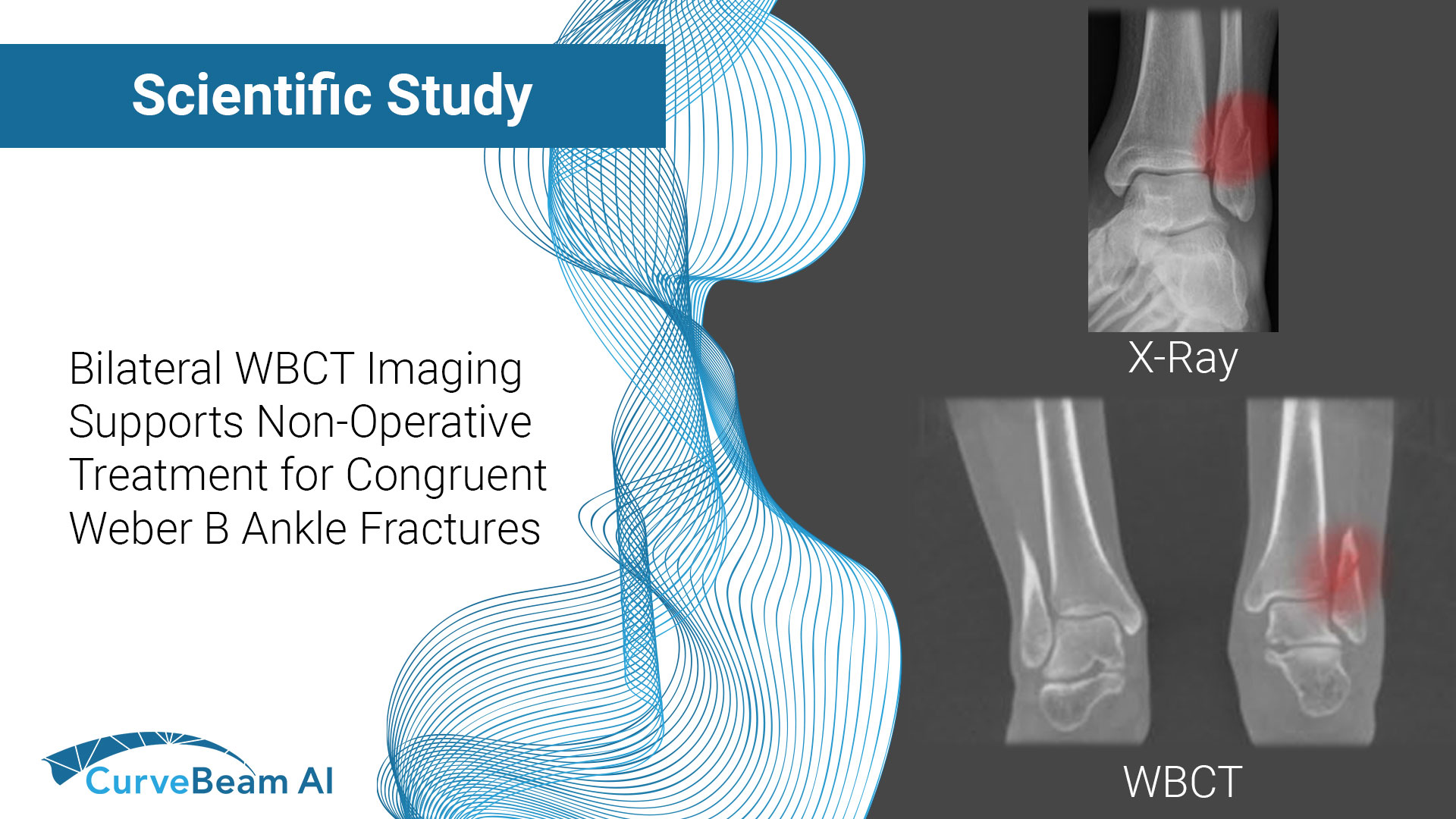 WeberBFractures